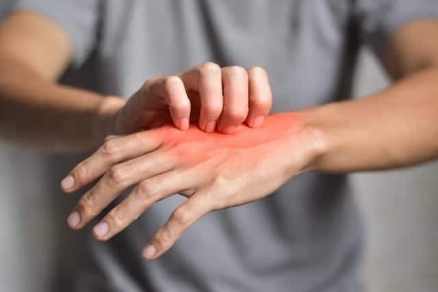 insect bites